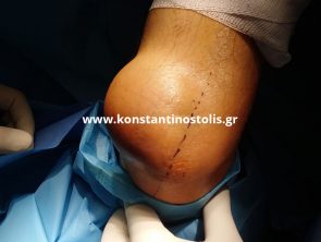 folliculitis