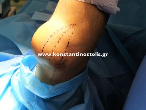 folliculitis