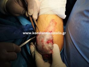 folliculitis