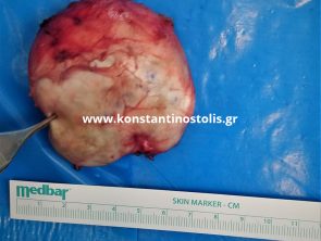 folliculitis