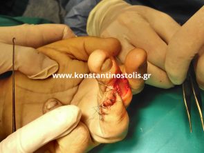 partial amputation