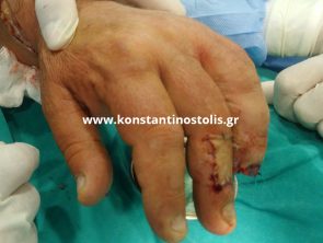 partial amputation