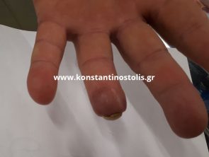 partial amputation