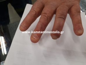 partial amputation