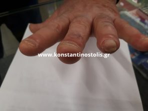 partial amputation